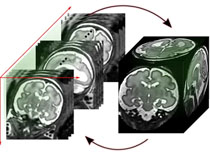 Fast volume reconstruction from motion corrupted stacks of 2D slices